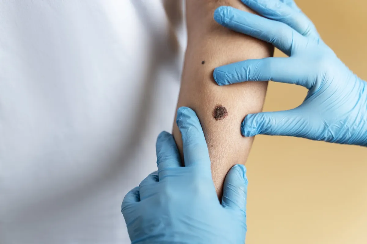 صورة لطبيب يفحص شامة