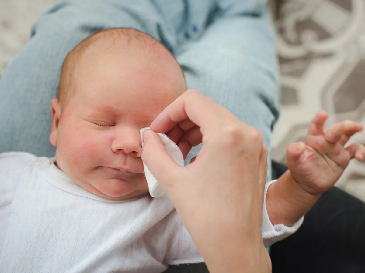 علاج رمد العين عند حديثي الولادة