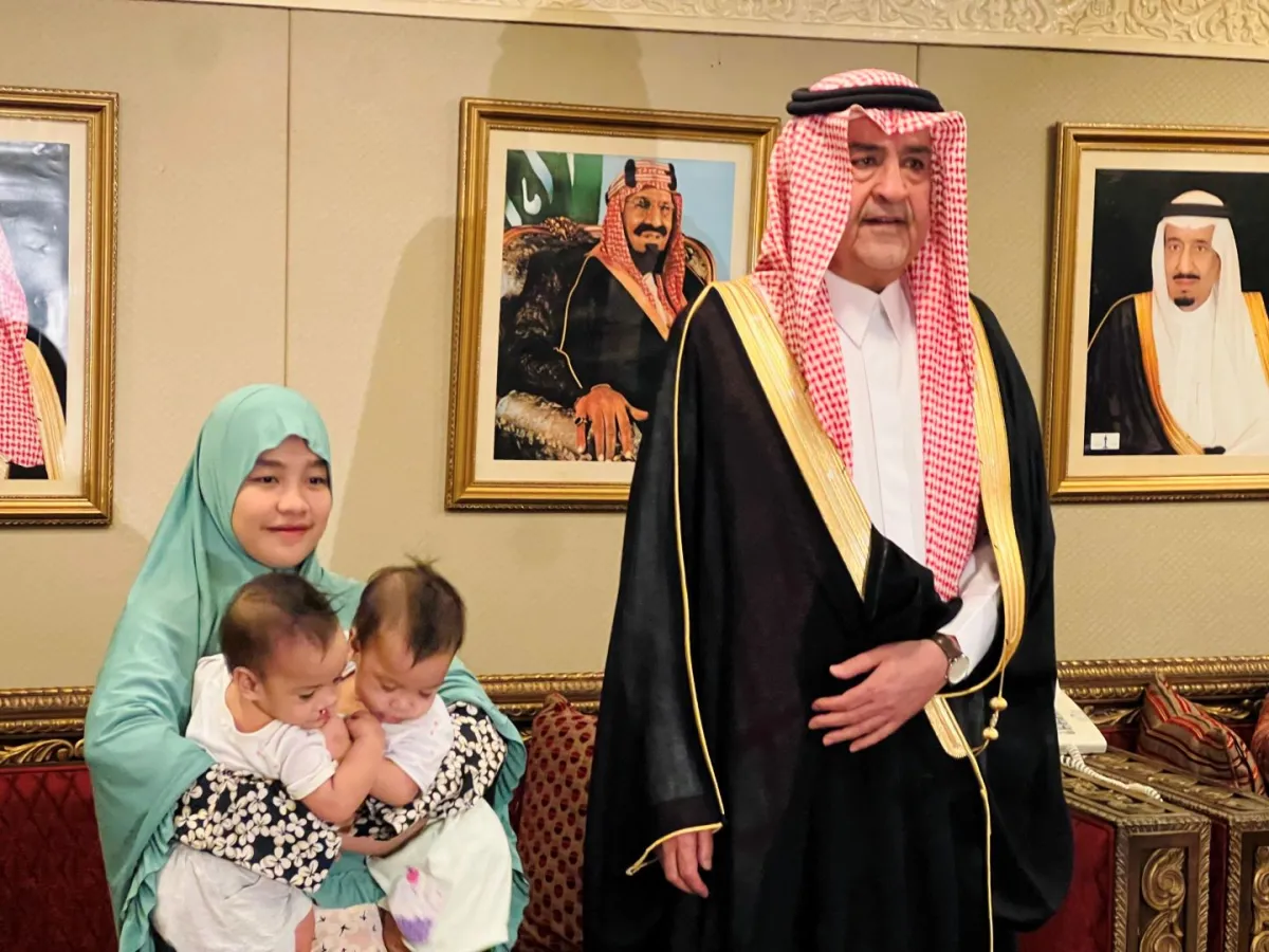 التوأم السيامي