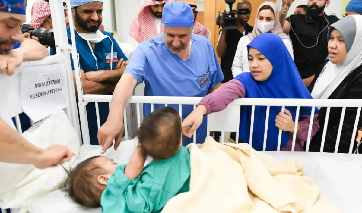 التوأم السيامي