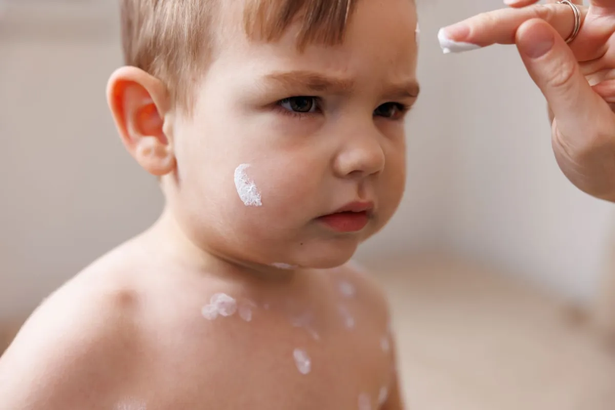 صورة الحساسية الجلدية لدى الطفل