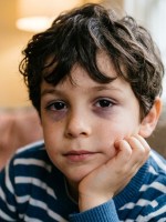 صورة لطفل يعاني من الهالات السوداء