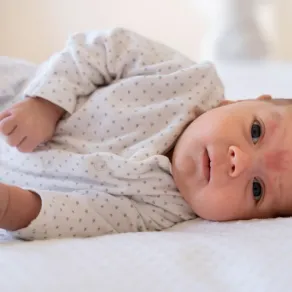 صورة لبقعة السلمون على جبهة المولود