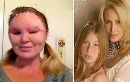 «فيلر» تجميل يتسبب في فقد سيدة الرؤية ويشوه وجهها
