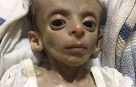 مرض نادر يحوِّل طفلاً حياً إلى هيكل عظمي!