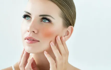 علاج الوردية الجلدية