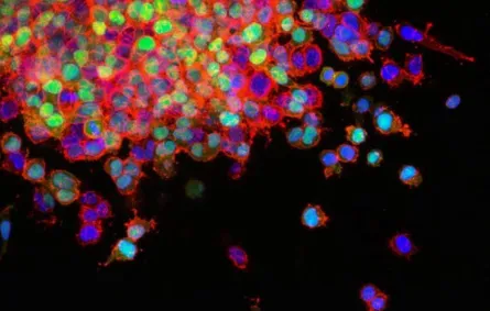 علاج جديد للسرطان المقاوم للأدوية