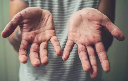 جدري القردة. الصورة من "وام"