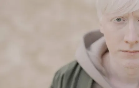 اليوم العالمي للمهق