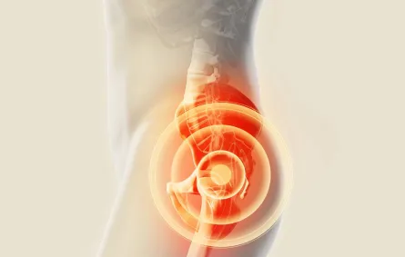 متلازمة اصطكاك الورك المفصلية «الورك الراقص» .. وأفضل طرق العلاج