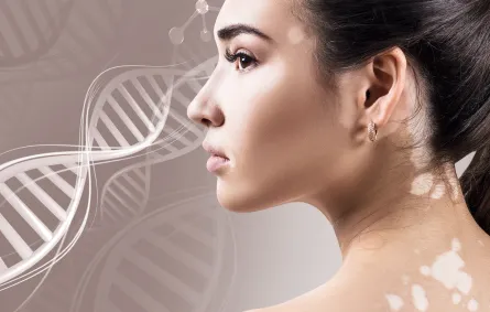 علاج البهاق