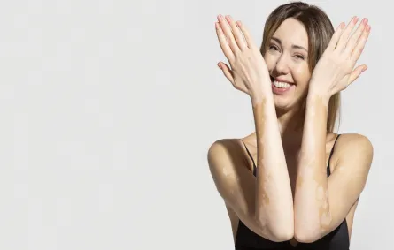 أسباب الإصابة بالبهاق وطرق الوقاية.. في اليوم العالمي للبهاق (المصدر: Freepik)