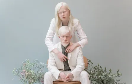 مصابان بمرض المهق