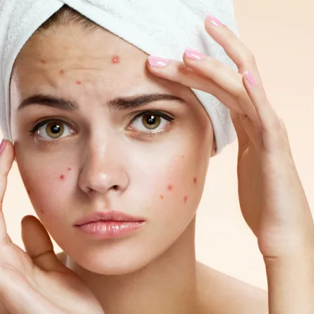 أنواع حبّ الشباب محمر وحارق وخفيف