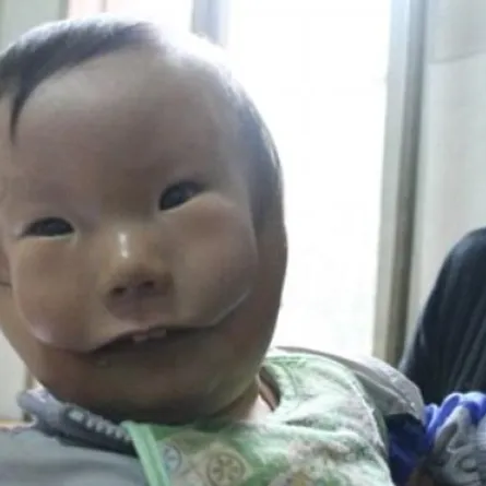 في الصين.."طفل ذو وجهين"