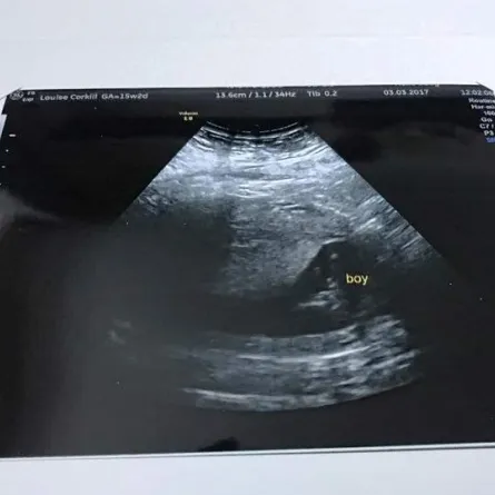 حامل تبكي بعد رؤية "وجه جدتها" المتوفاة في صورة فحص الجنين