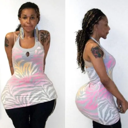 السجن لطبيبة تجميل مزيفة متحولة حقنت مرضاها بالأسمنت والغراء