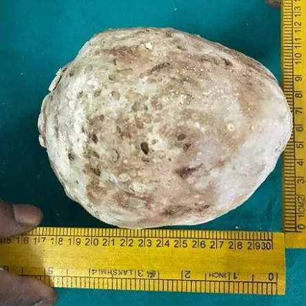 استخراج حجر وزنه 1.36 كلغ من جسم رجل