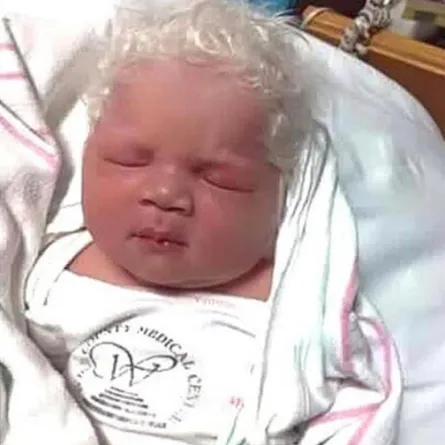 رضيع يولد بشعر أبيض كالثلج: لماذا؟