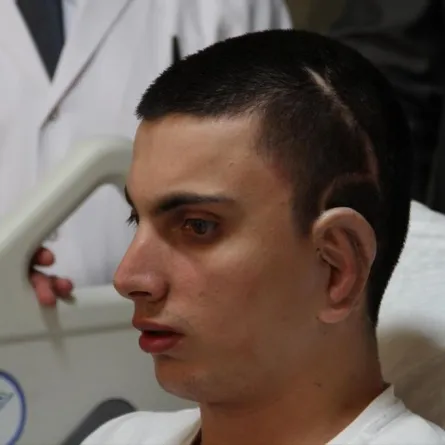 للمرة الأولى.. زرع أذن مستخلصة من غضروف