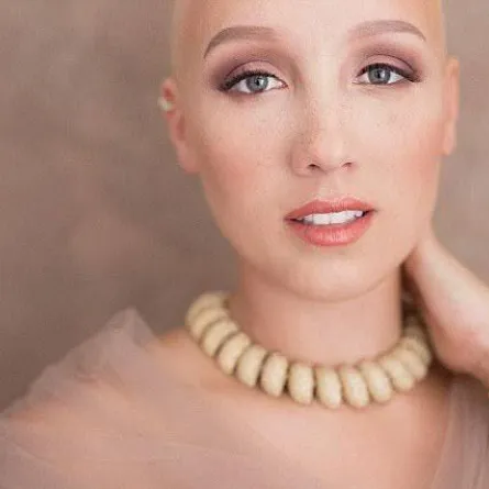 بالصور.. لماذا أطلّت هذه العروس "صلعاء" يوم زفافها؟