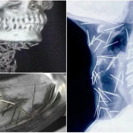 بالصور: 150 دبوساً داخل جسد مريض.. تثير دهشة الأطباء في الهند
