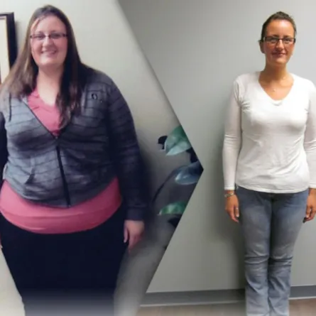 تعرفي إلى أضرار ومنافع عمليات قص المعدة