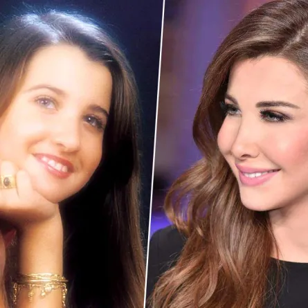 نجمات قبل وبعد الفيلر... لاحظوا الفرق الصادم!