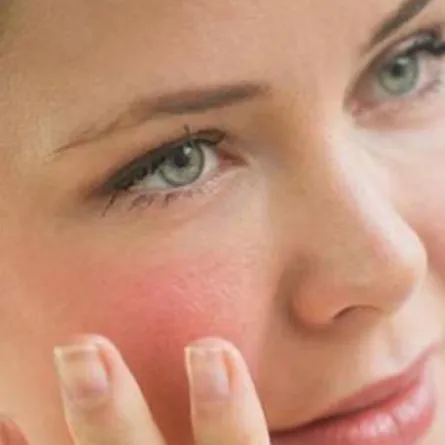 السمنة تفاقم أعراض «الذئبة الحمراء» لدى السيدات!