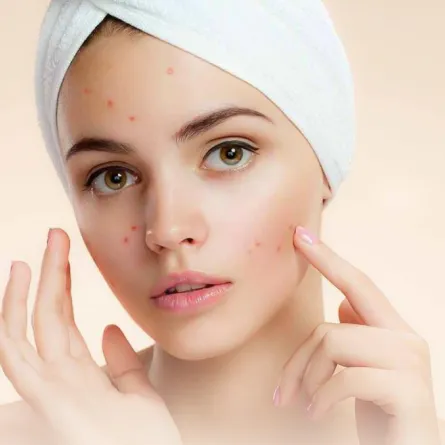 عادات يومية وراء حبوب الوجه المزعجة