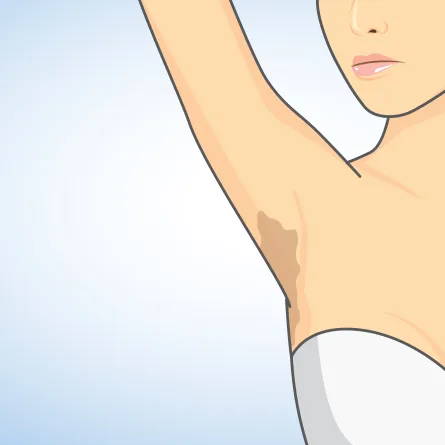 خلطة بياض الثلج لتفتيح منطقة الإبط