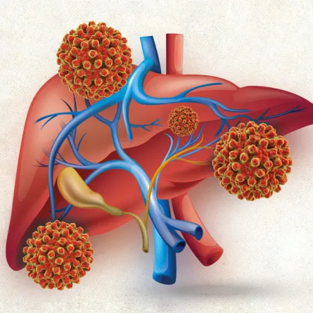 أعراض التهاب الكبد الوبائي في بضعة سطور...