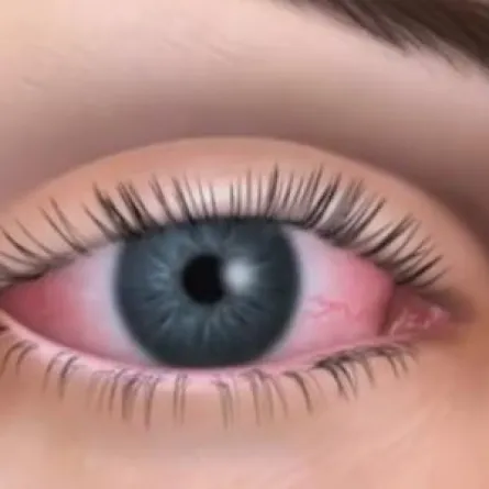 دراسة جديدة: الصداع النصفي يسبب جفاف العيون