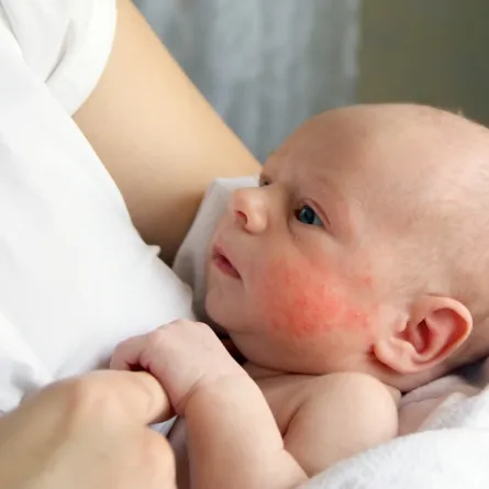 احمرار جلد الرضيع  وعلاجات منزلية