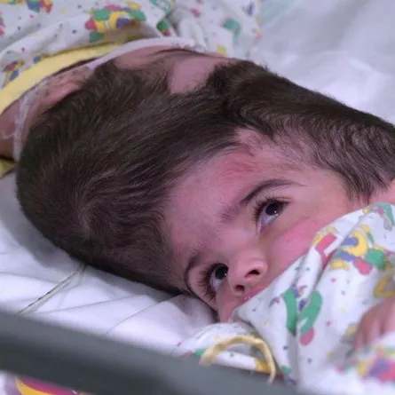 نجاح عملية جراحية استغرقت 50 ساعة لفصل توأم ملتصق