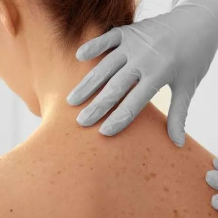 سرطان الجلد: قريبًا لقاح جديد مضادّ