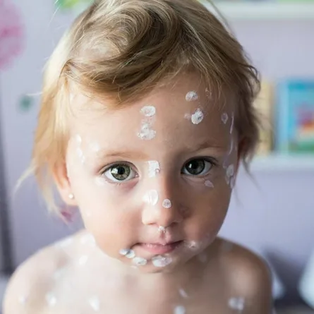 صورة لطفل مصاب بالأكزيما