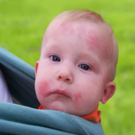 صورة لطفل يعاني من الطفح الجلدي