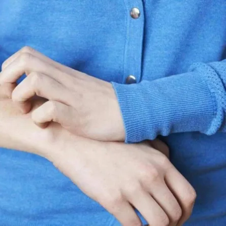 علاج الإكزيما نهائياً