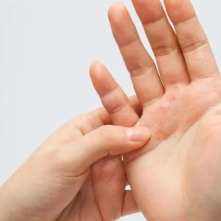 الضمان الصحي: وثيقة التأمين الصحي الموحدة تغطي تكاليف علاج الصدفية