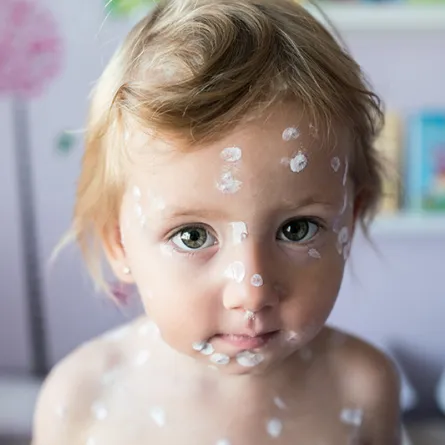 أعراض الحصبة عند الأطفال