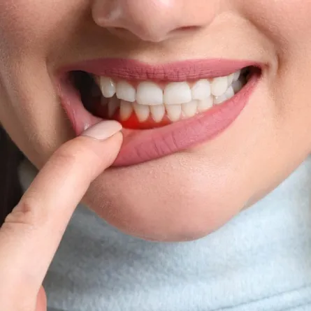 التهابات اللثة تؤدي إلى السكتة الدماغية والنوبات القلبية