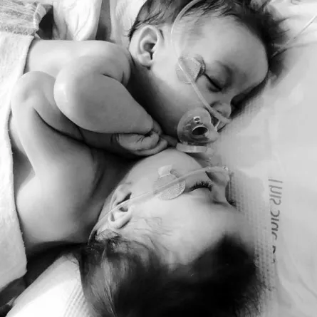 قصة فصل توأم ملتصق من الصدر والبطن