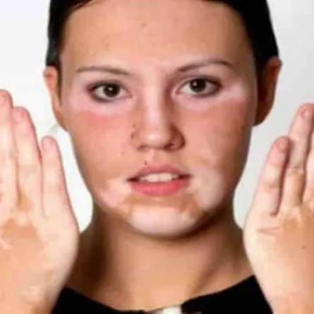 الصحة السعودية: 3 أنواع لمرض البهاق وهذه أعراضه