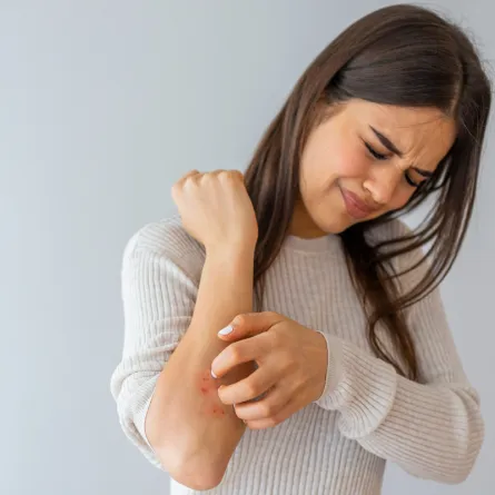  مرض الصدفية.. يُعالج بمواجهة الضغوط النفسية