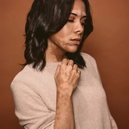 أسباب مرض البهاق والعلاجات المتاحة