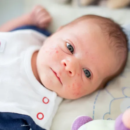 كيفية علاج الإكزيما لدى الرضع