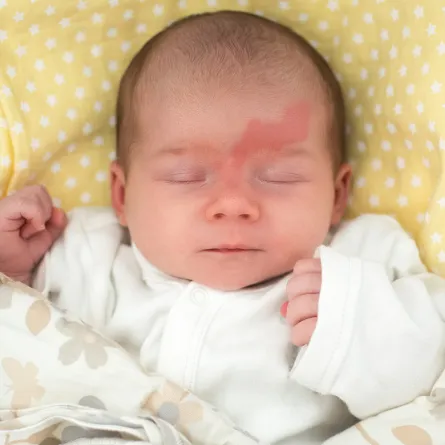 وحمة الفراولة ورم وعائي طفولي 