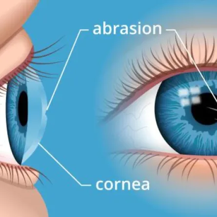 دراسة: تلف الأعصاب في قرنية العين علامة على الإصابة بكورونا طويل الأمد