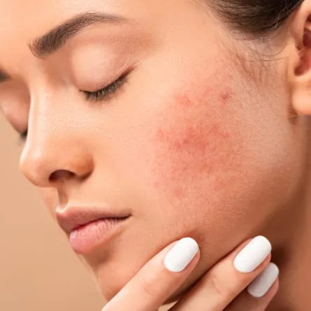 علاج تهيج البشرة بعد التشقير